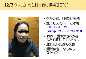 12/03:ケガから11日後の様子(自宅にて)| 過敏症/化学物質過敏症(CS)の私。(50代女性)。姉夫婦と晩御飯を食べに出ました。食事と一緒にワインも頂きました。 10時半頃お店を出て そこから 7～8m の処で意識が無くなり、顔からバサッと倒れました。| 健康相談会の治癒例